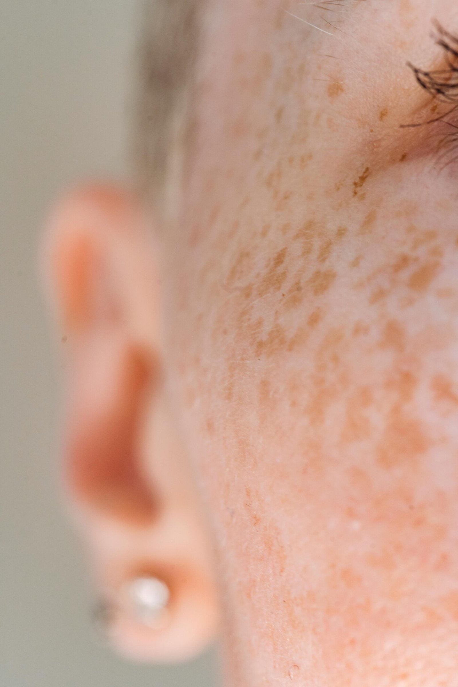 Pigmentation on skin
