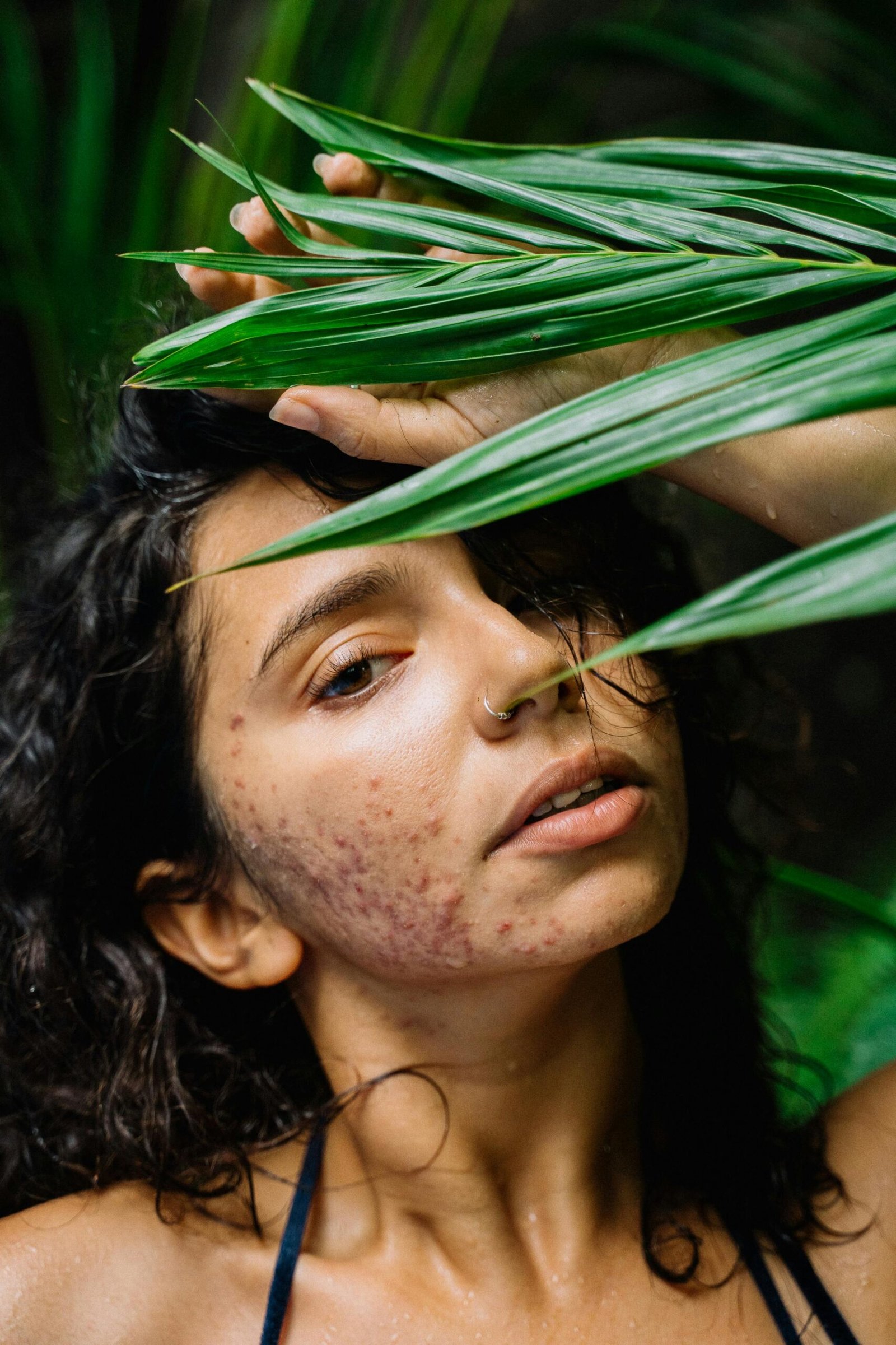 Post-inflammatory hyperpigmentation pimple marks