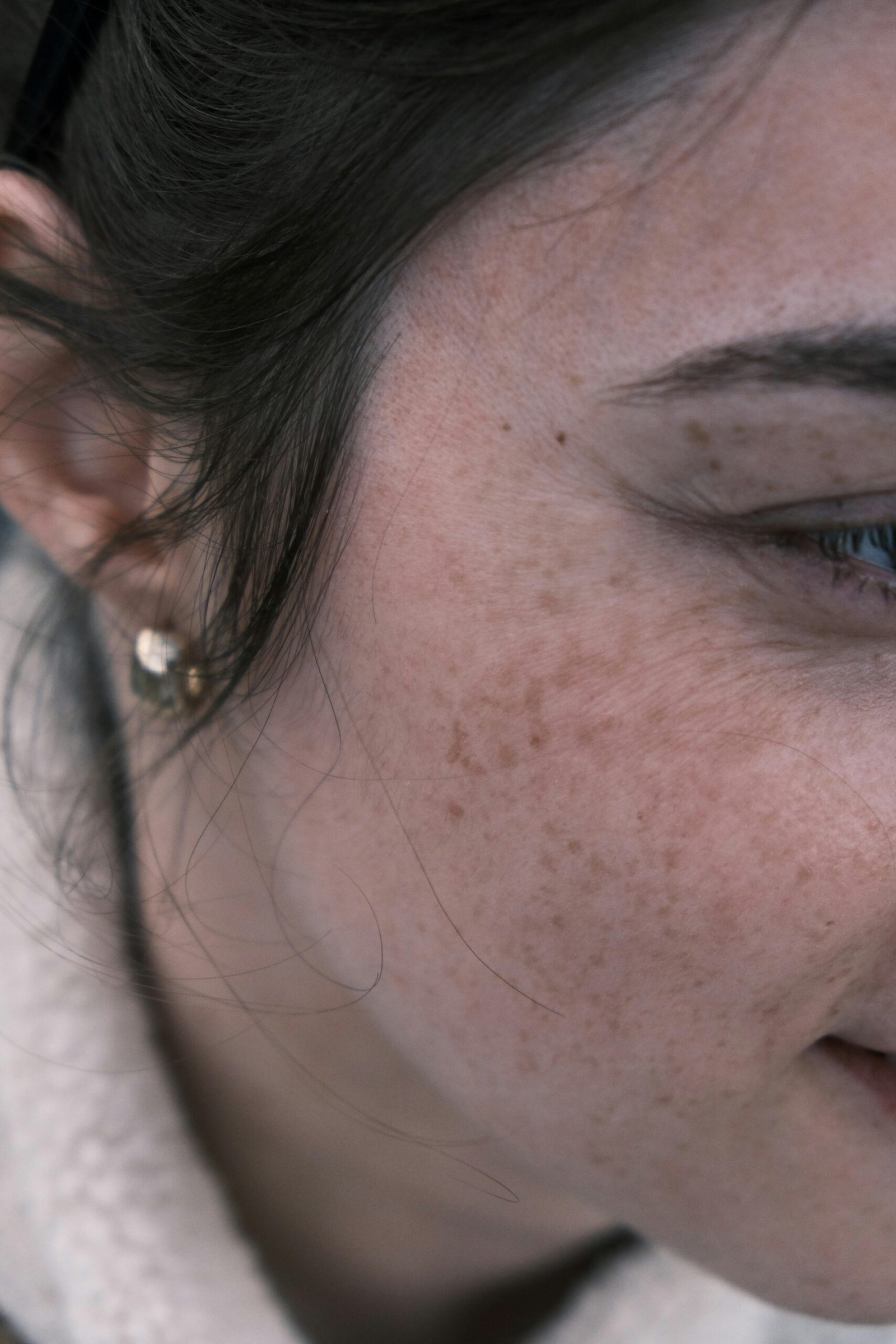 Melasma and skin pigmentation