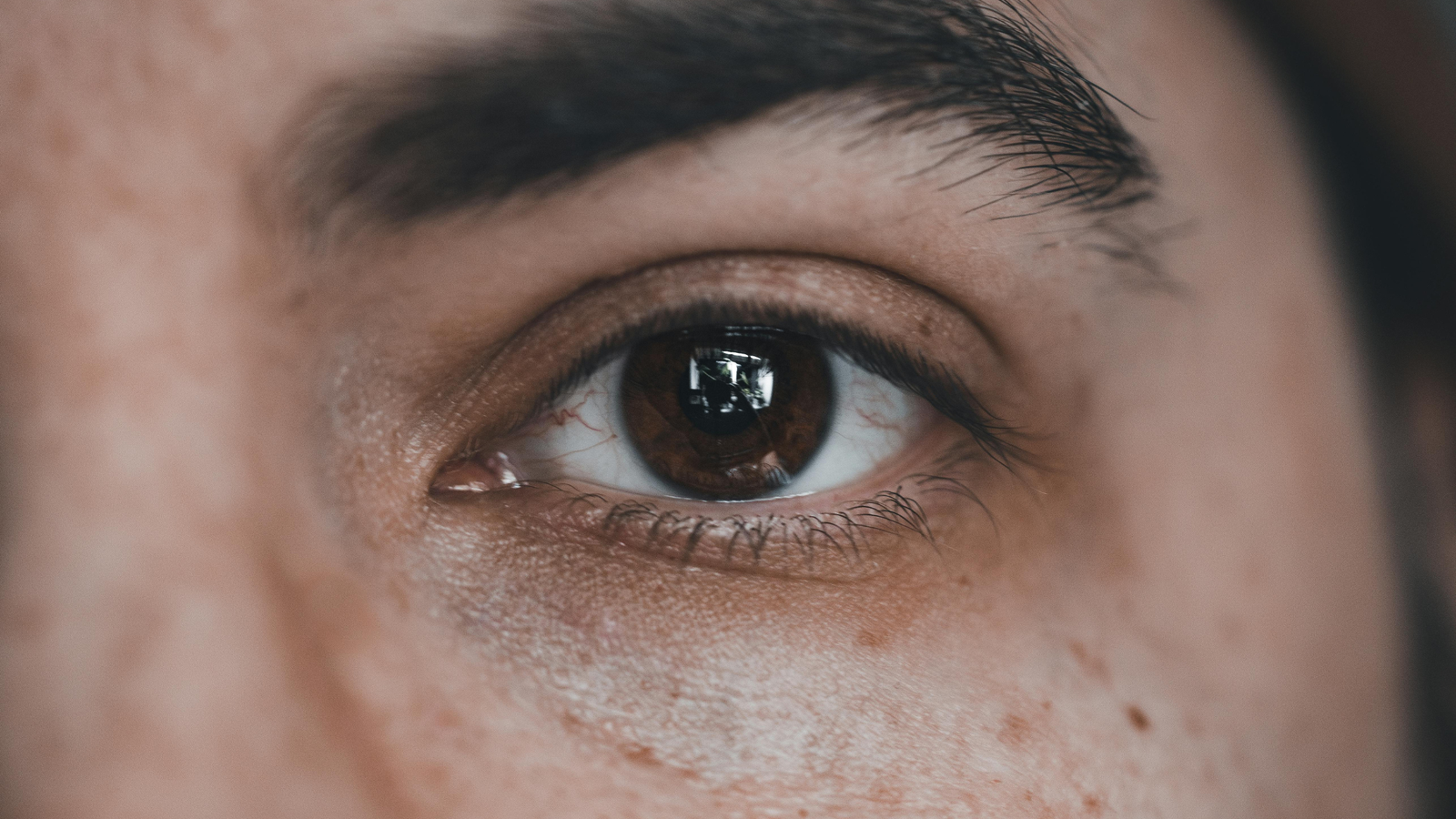 Hereditary Dark Circles: What Creams Miss & What Works