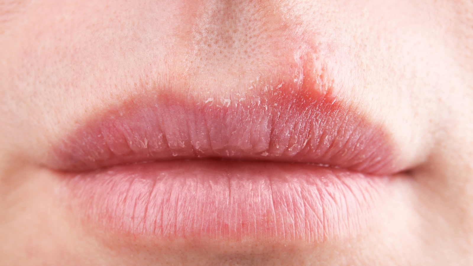 Smoker's lines around the upper lip