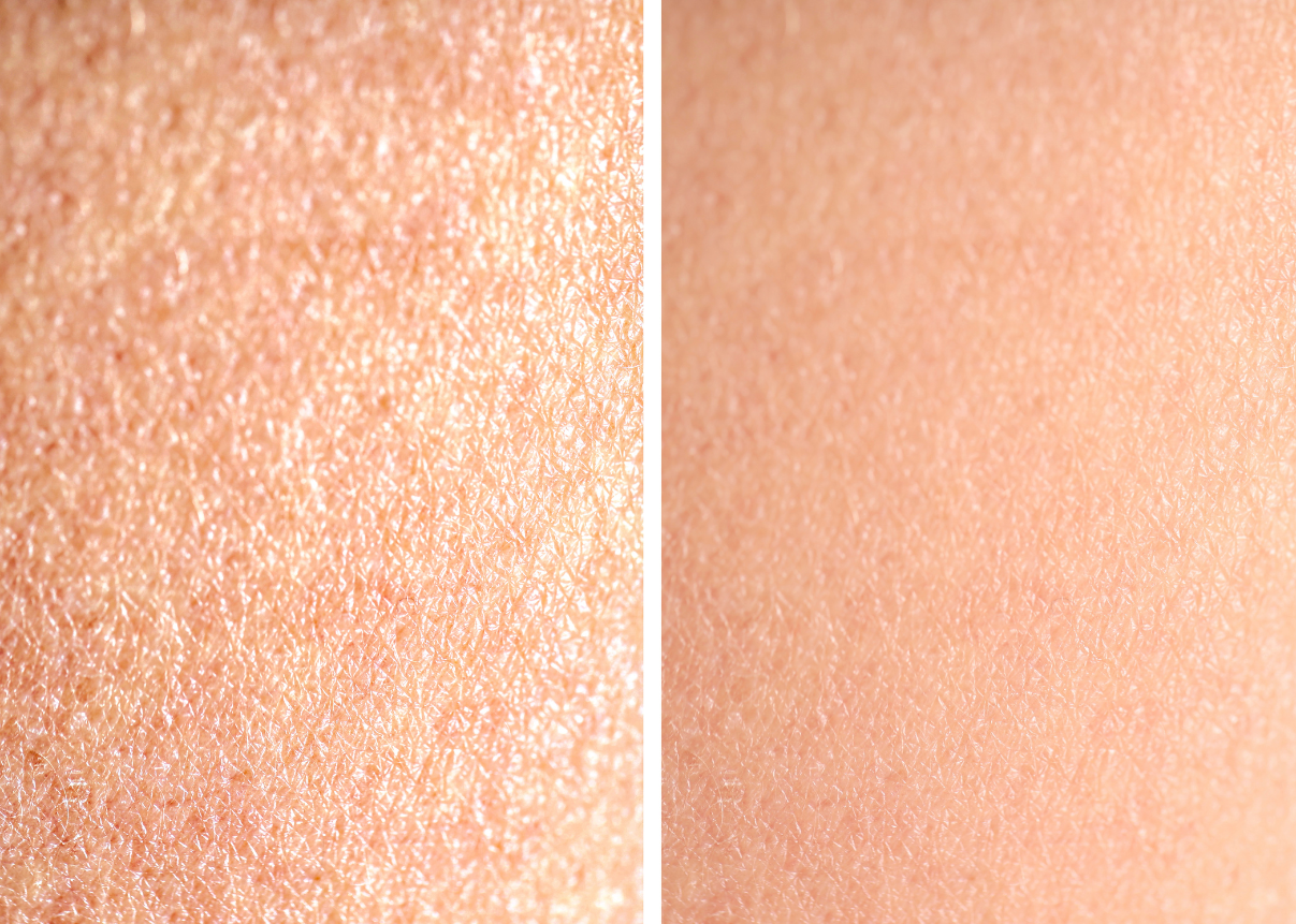 Comparison of uneven skin tone and rough skin texture