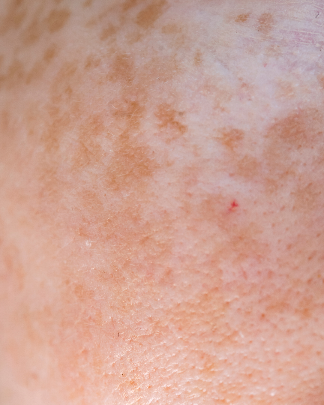 What is uneven skin tone
