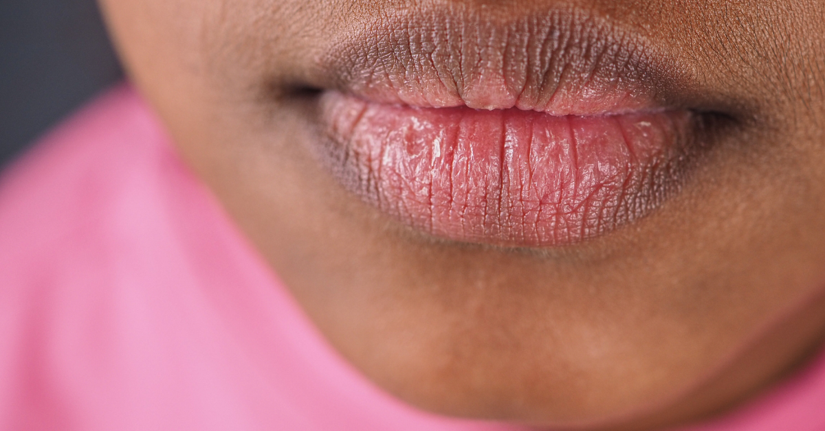 Dark lips and perioral pigmentation
