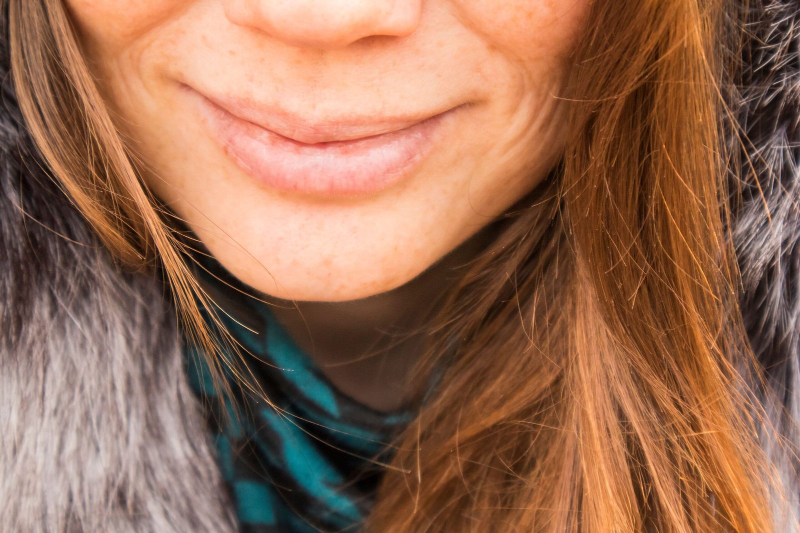 Smile wrinkles and deep nasolabial folds at a young age
