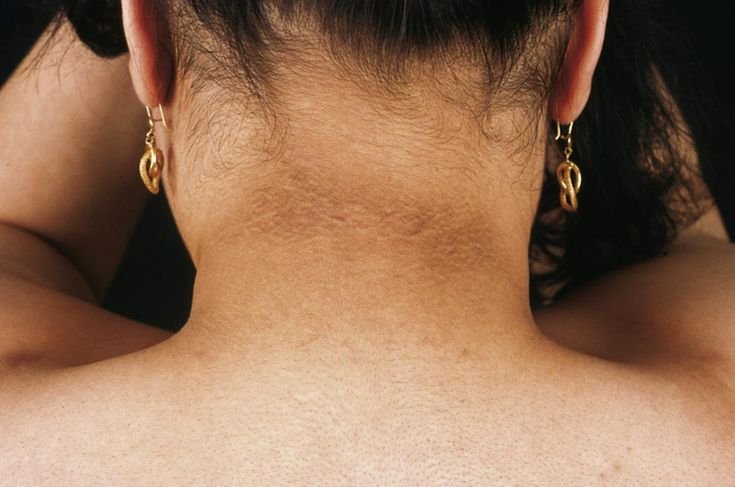 Neck darkening that could be something other than hyperpigmentation
