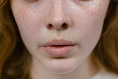 melanotan freckles face Freckles on Face: Why Do